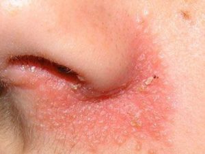 Симптомы себорейного дерматита на лице