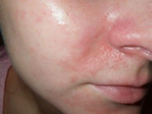 Пузырьки аллергии на лице